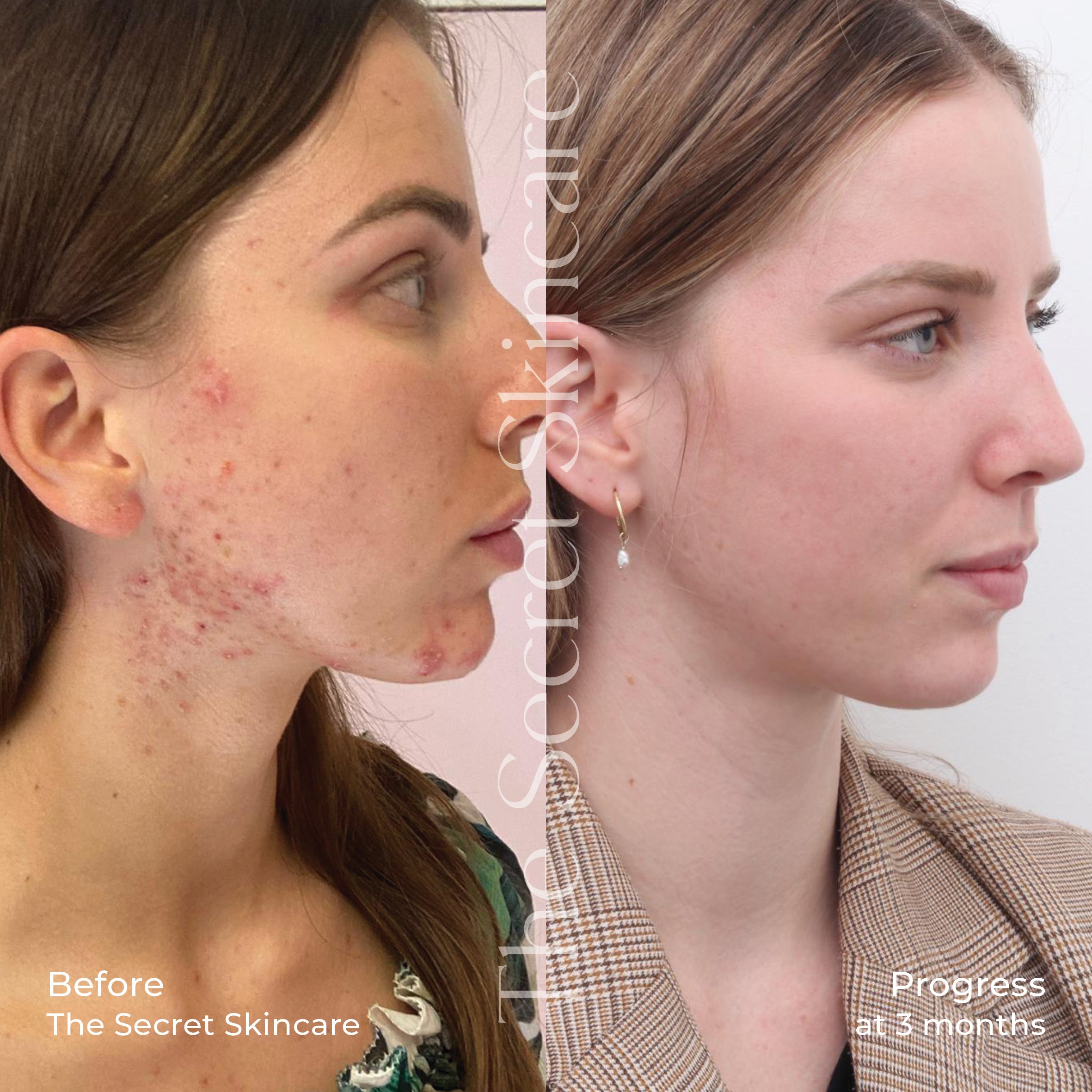 The Acne Set
