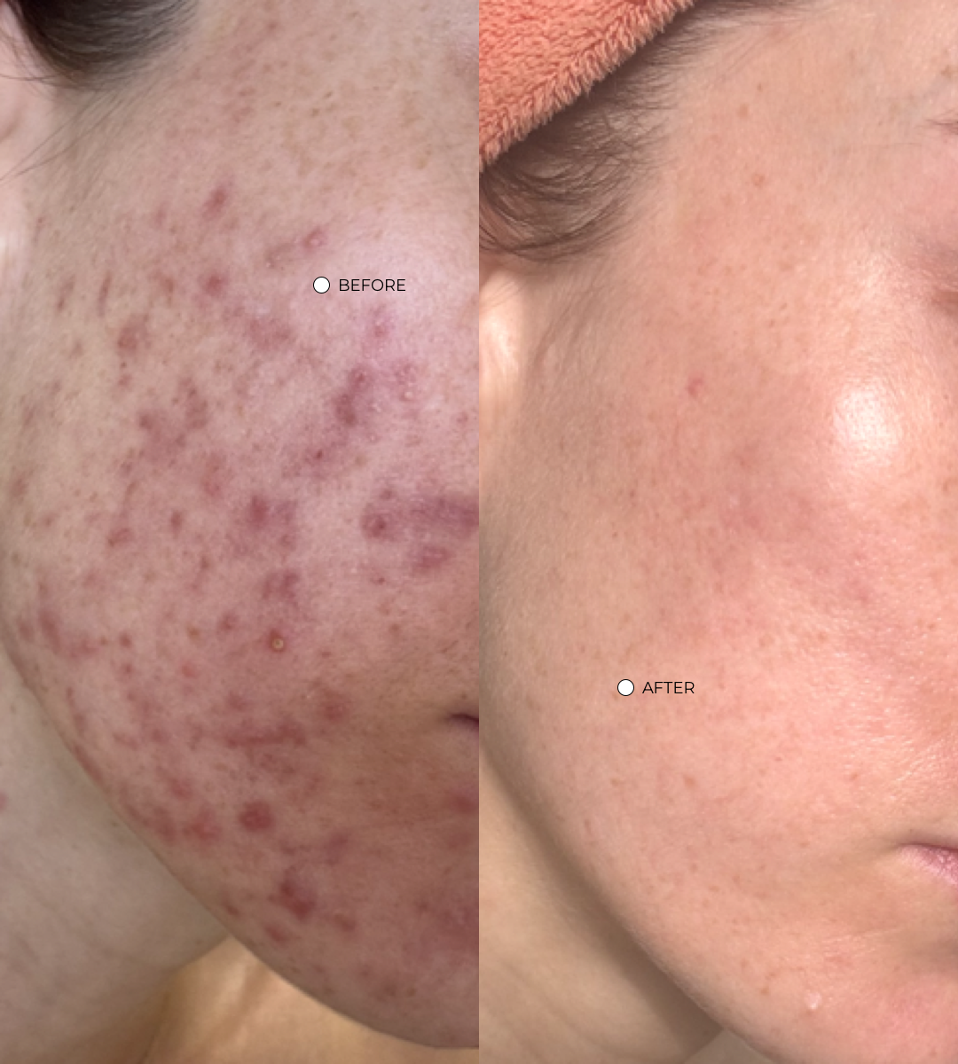 Spot Treatment Refill