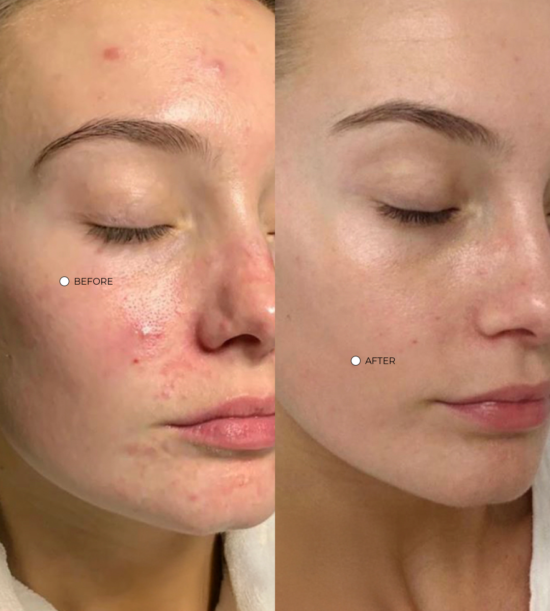 Spot Treatment Refill
